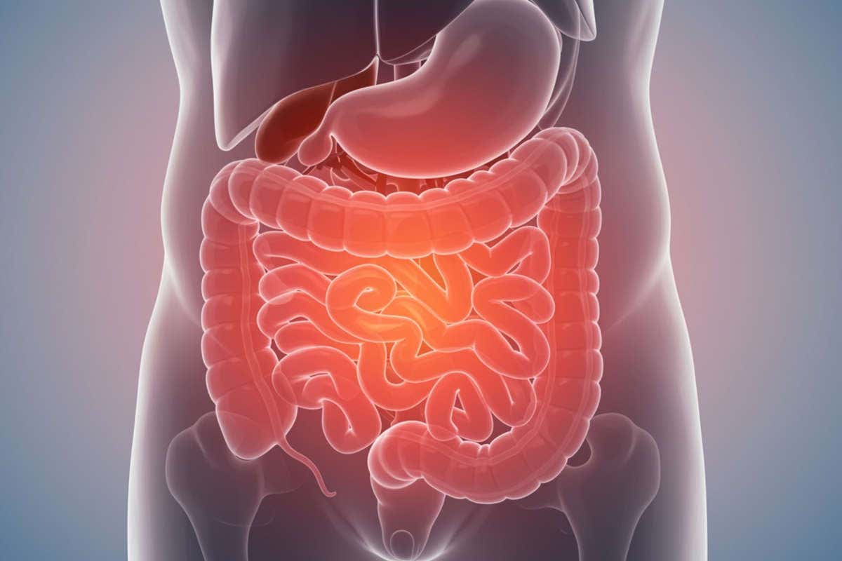 Polipi intestinali e tumore del colon: tutto ciò che devi sapere