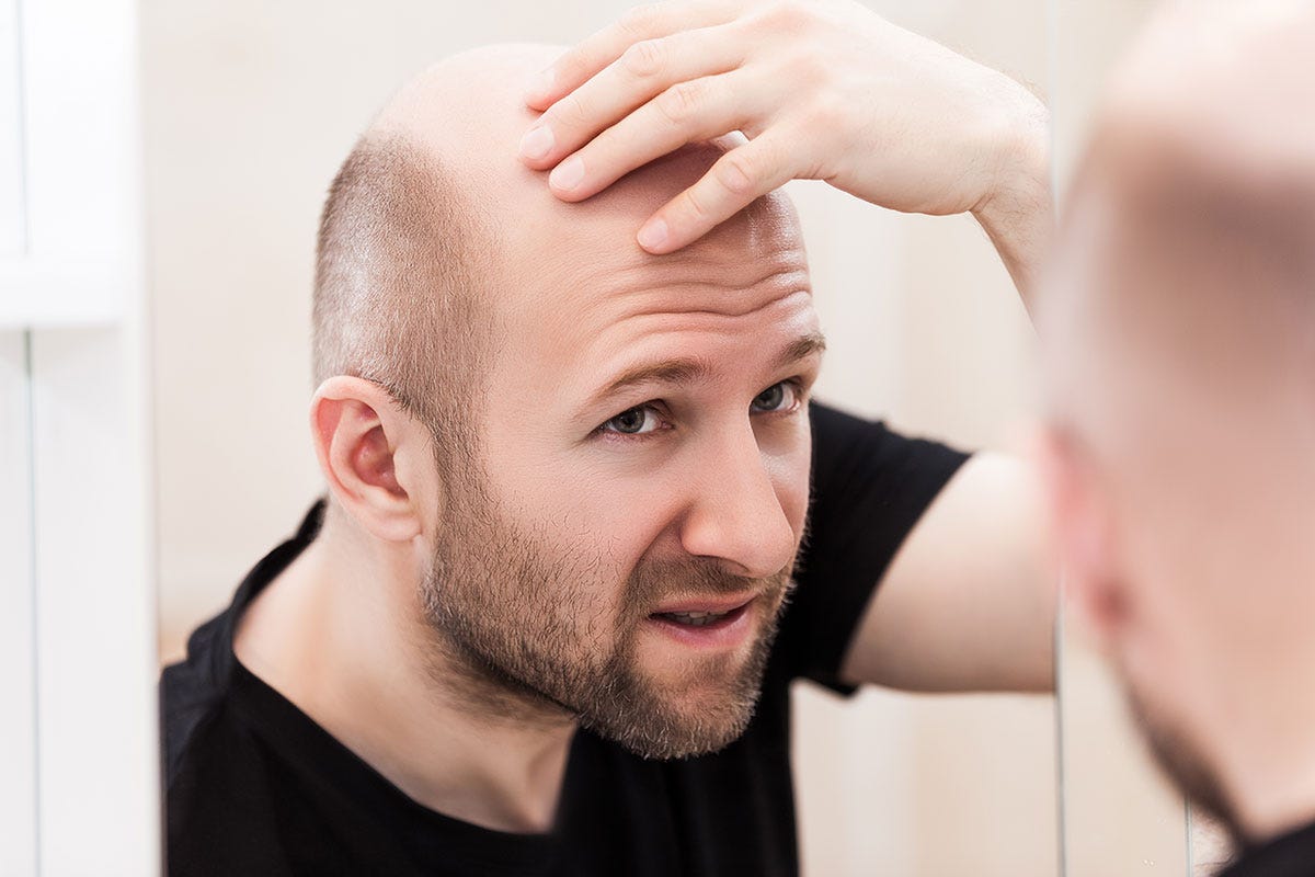Caduta dei capelli, un problema Tiroide, sistema immunitario e stile di vita: ecco le cause della calvizie